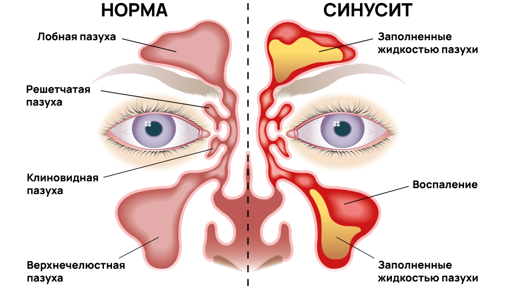 Синусит в пазухах