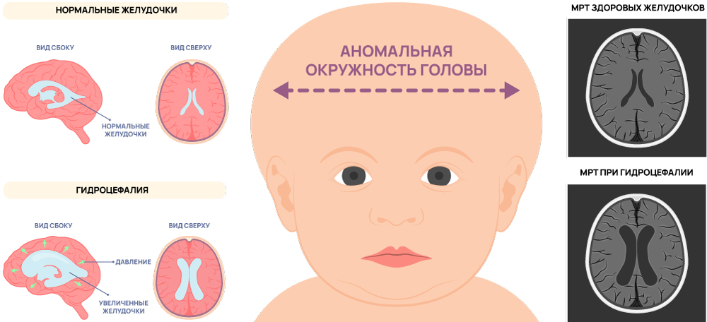 Гидроцефалия у новорожденных