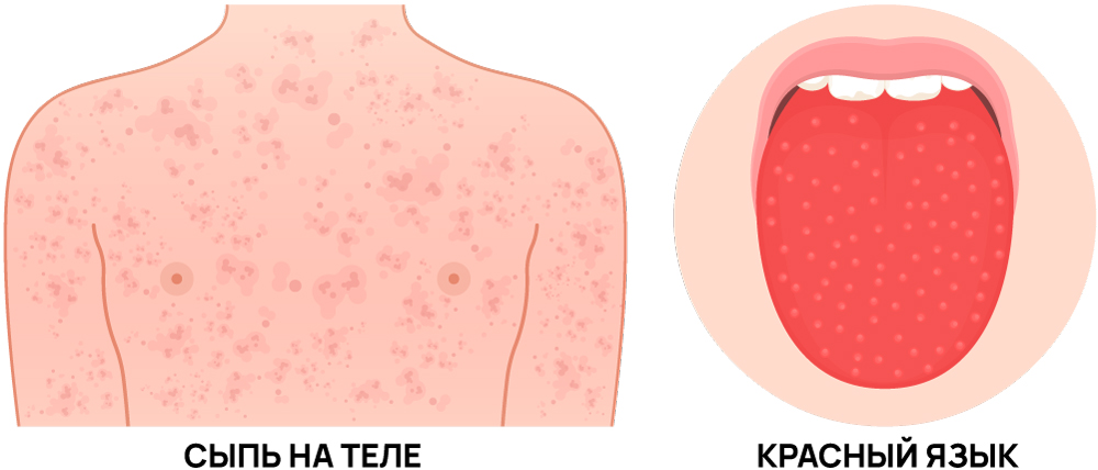 Признаки скарлатины