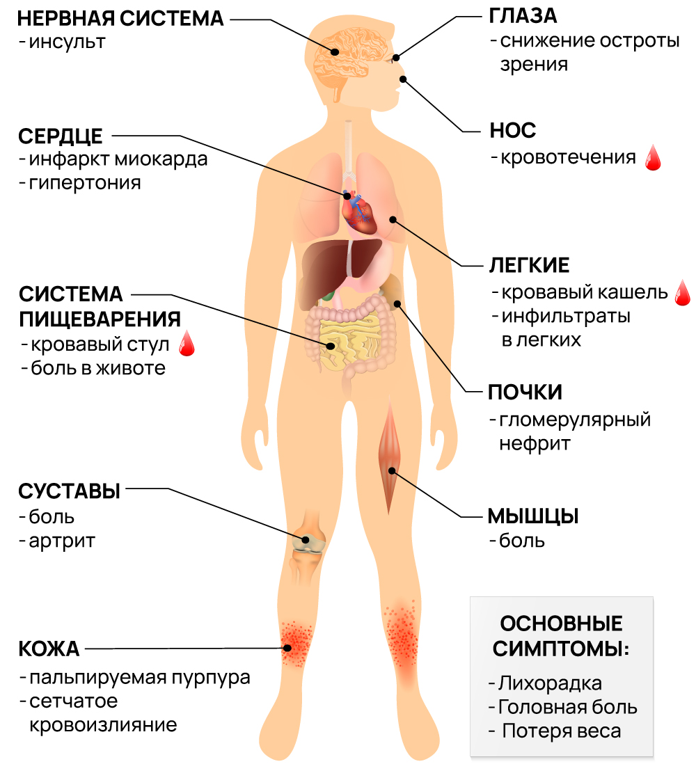 На что влияет васкулит