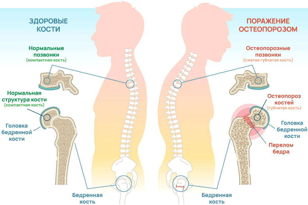 Кости, пораженные остеопорозом