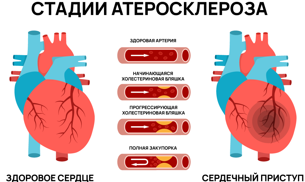 Стадии атеросклероза