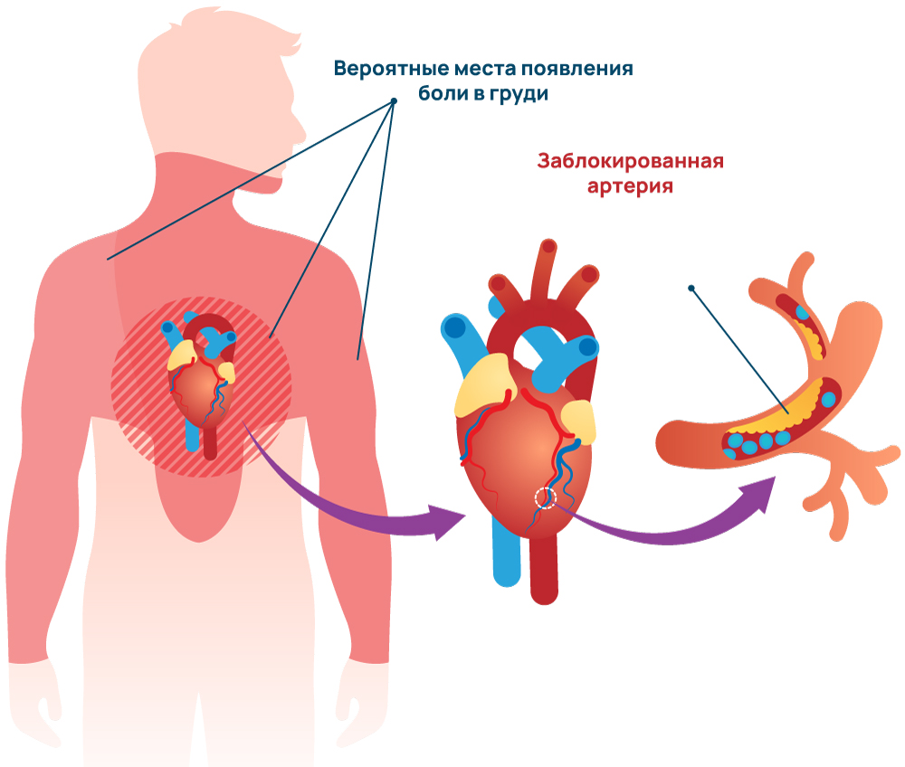 Боль в груди при стенокардии