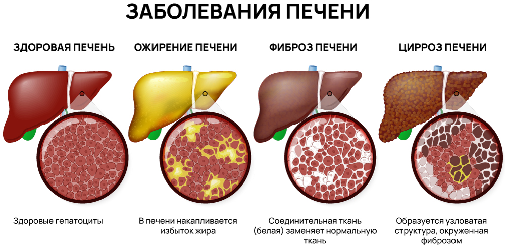 Заболевания печени