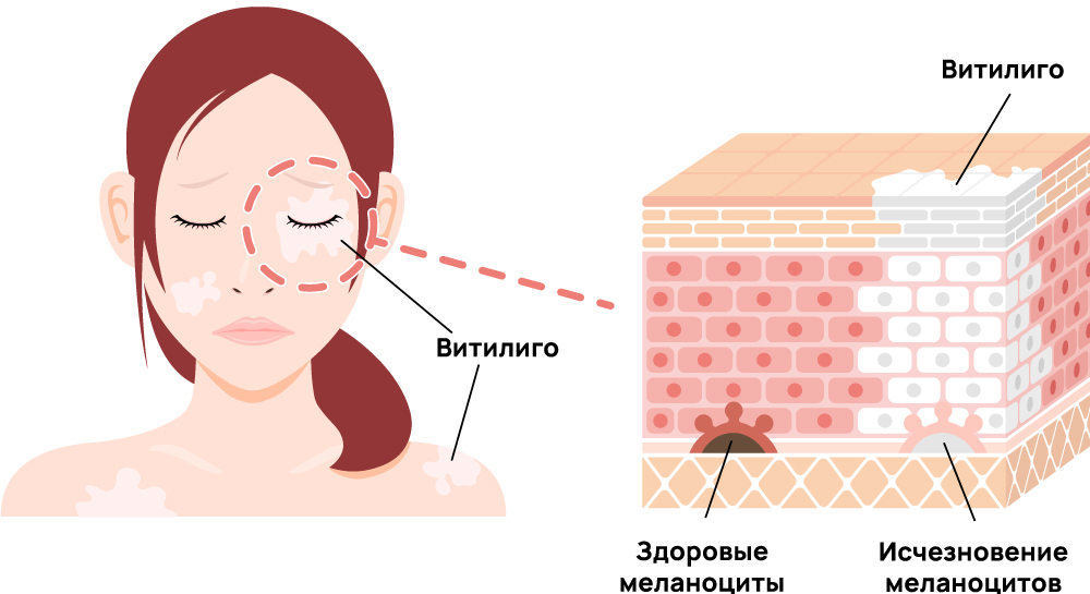 Проявление витилиго на коже