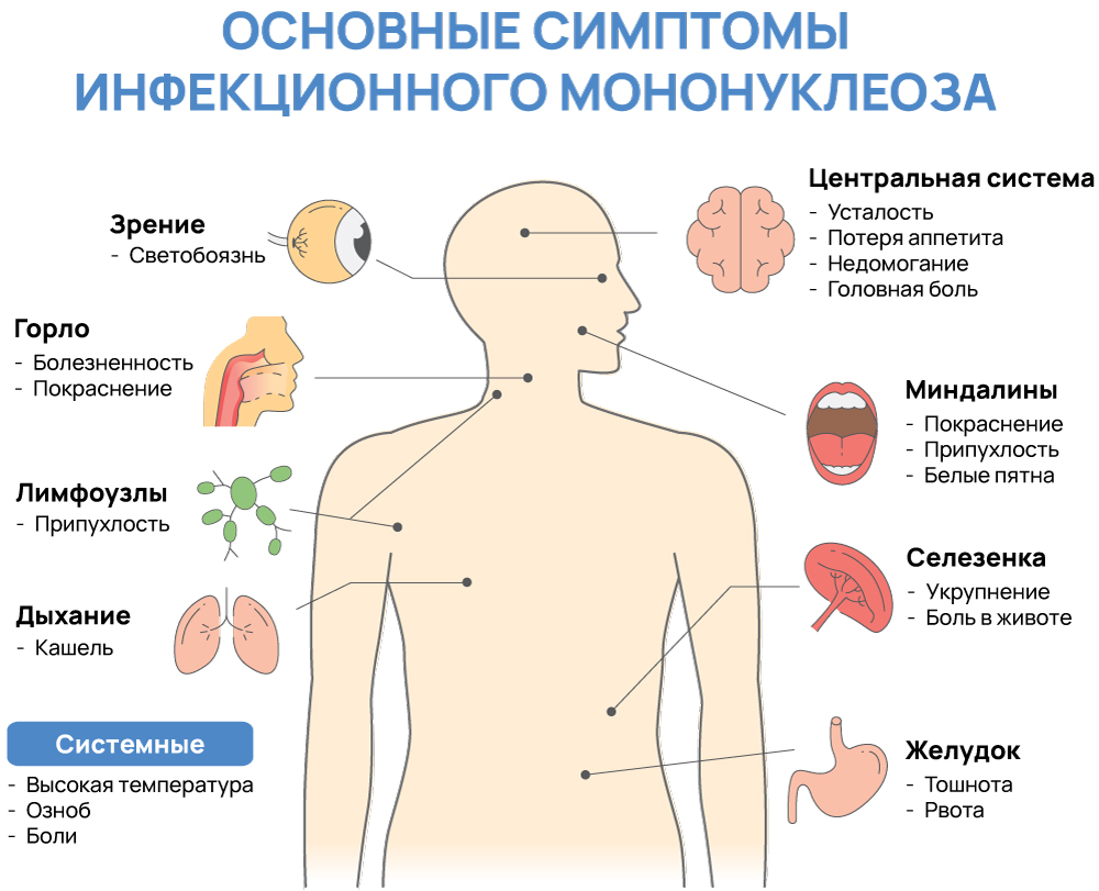 Симптомы мононуклеоза