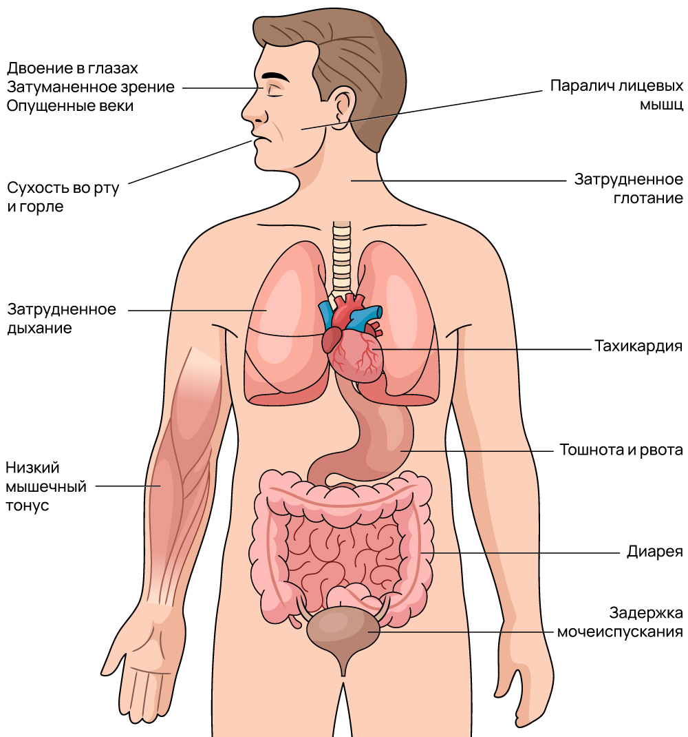 Симптомы ботулизма