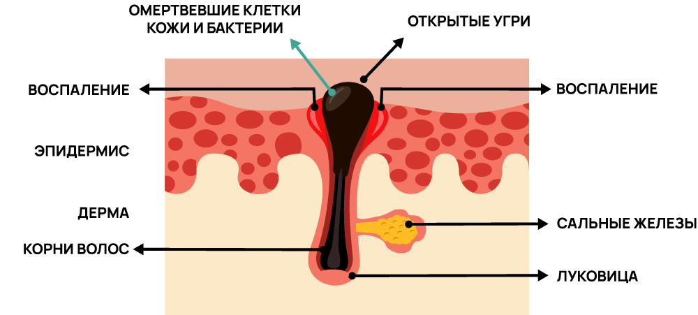 Как выглядит комедон