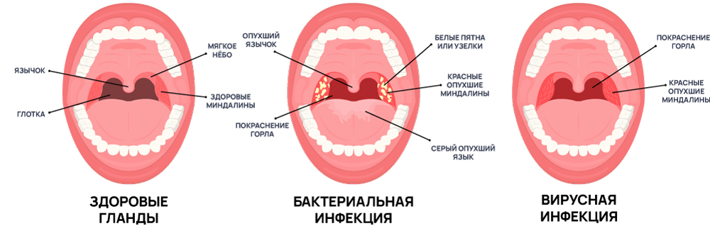 Симптомы тонзиллита