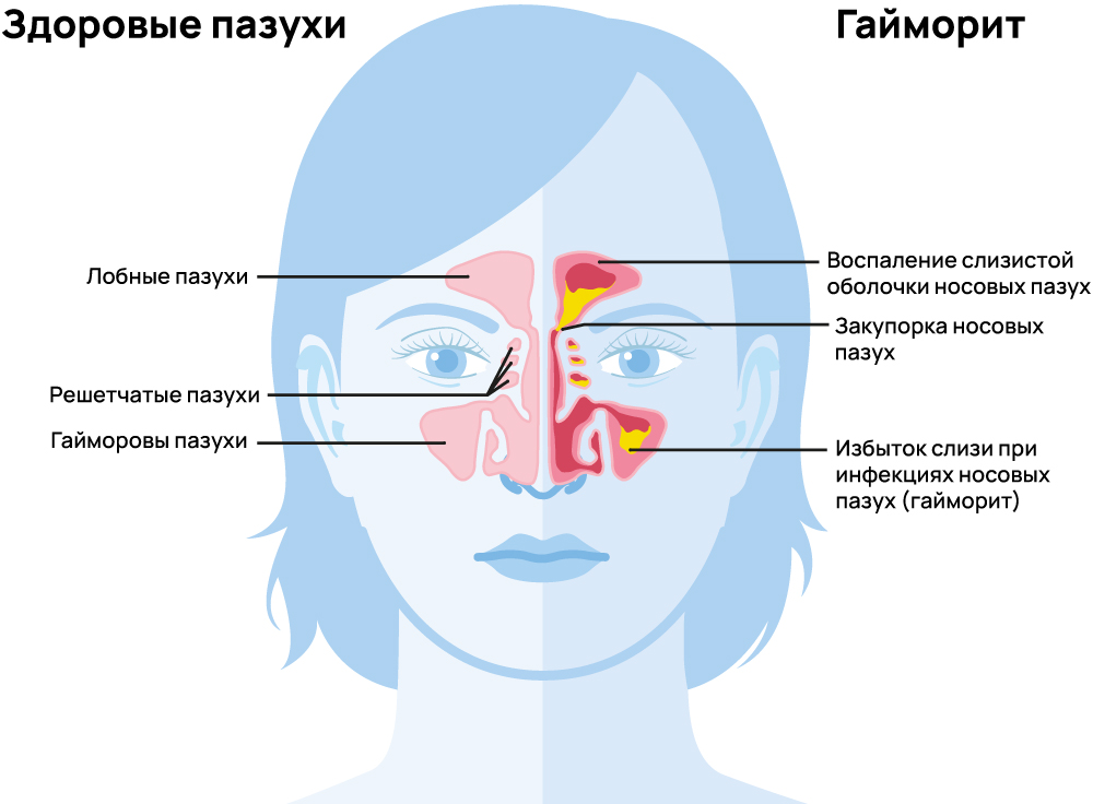 Гайморит