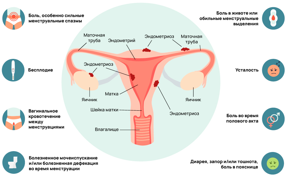 Симптомы эндметриоза