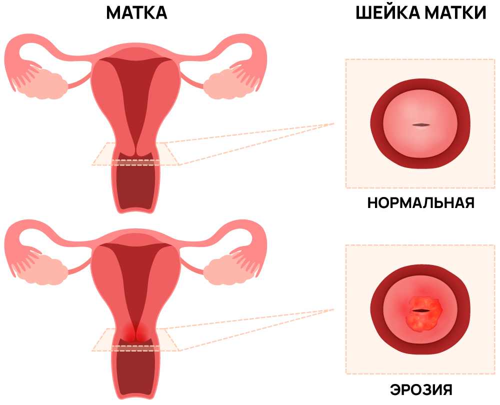 Эрозия шейки матки