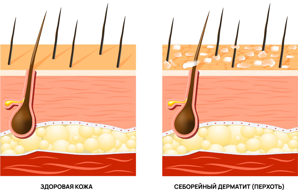 Перхоть