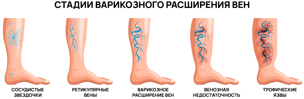 Стадии варикоза