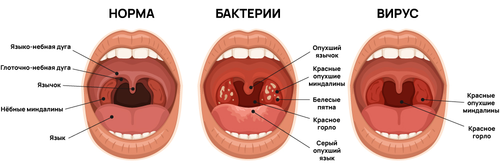 Вирусный и бактериальный фарингит