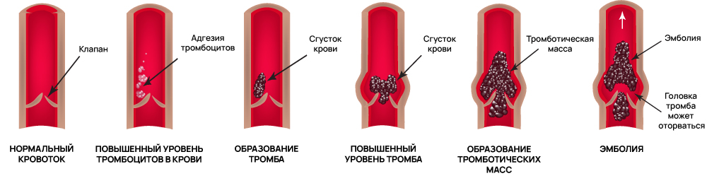 Образование тромба