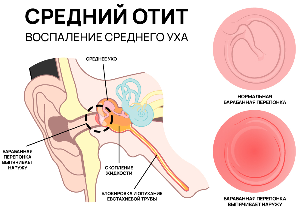 Воспаление среднего уха