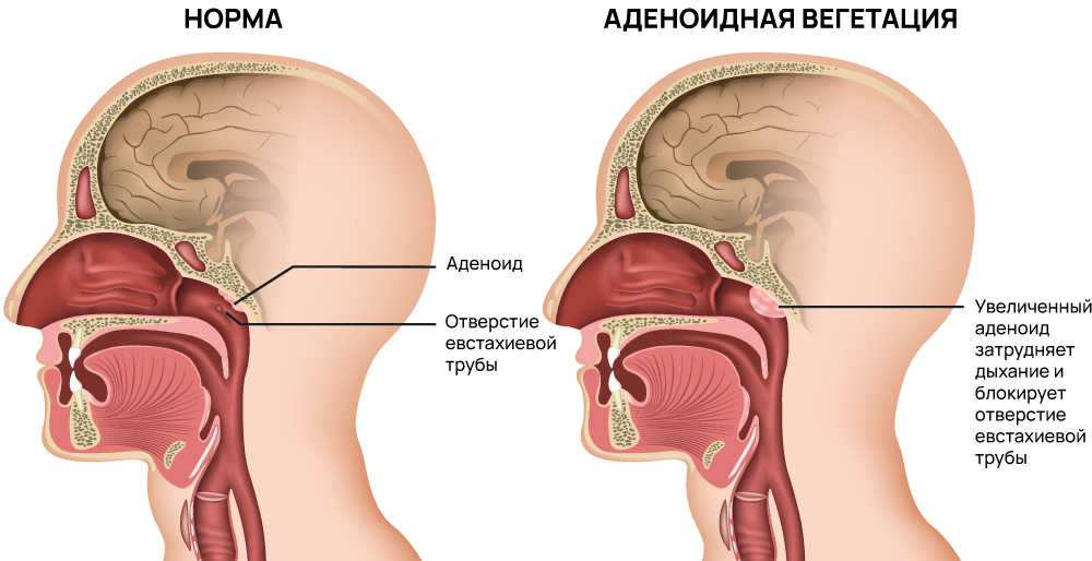 Аденоиды