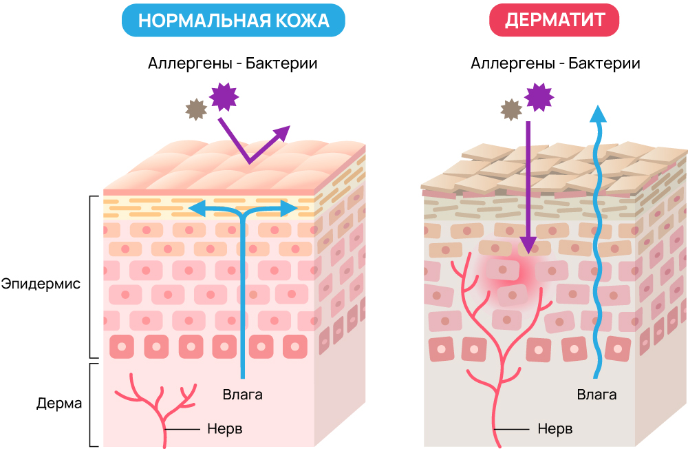 Нервный дерматит