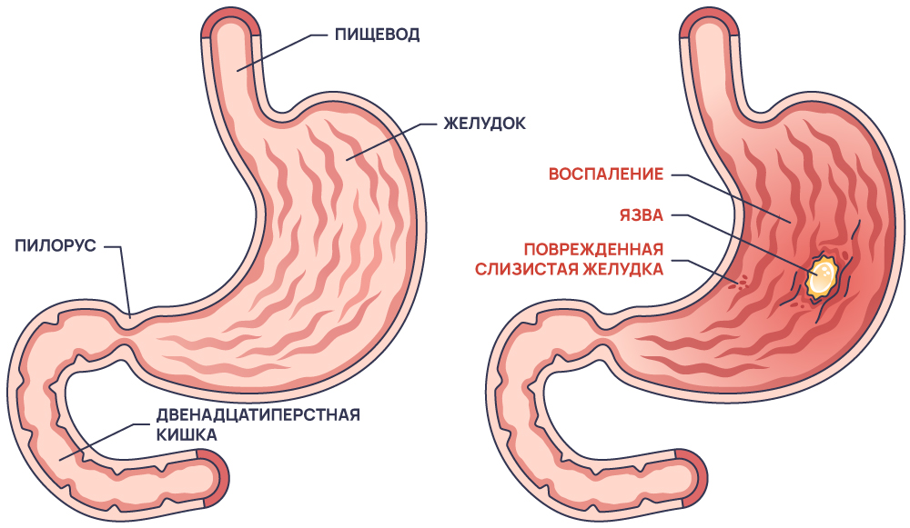 Гастрит