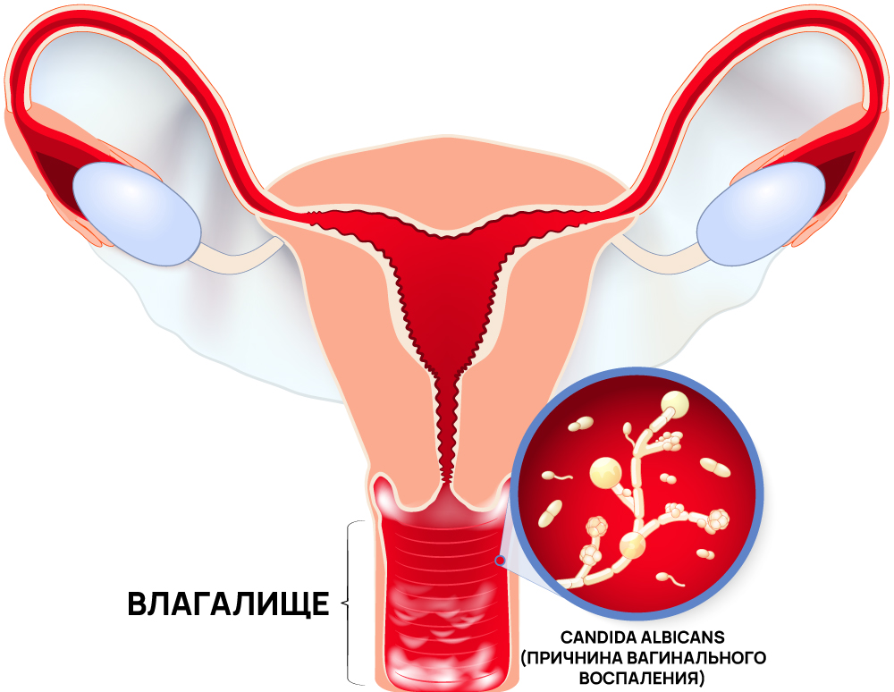 Молочница у женщин