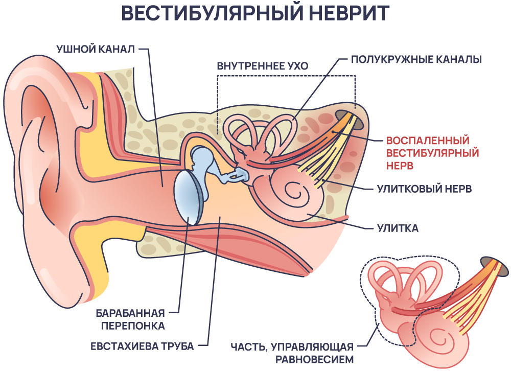 Вестибулярный неврит