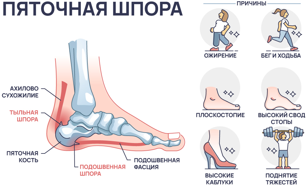 Пяточная шпора у человека