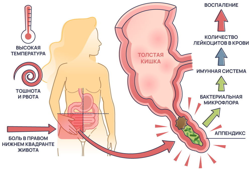 Симптомы аппендицита