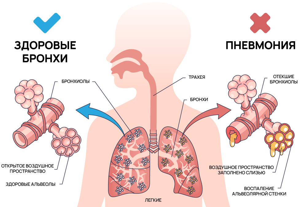 Пневония