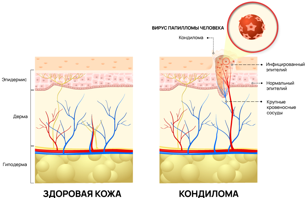 Кондилома на коже