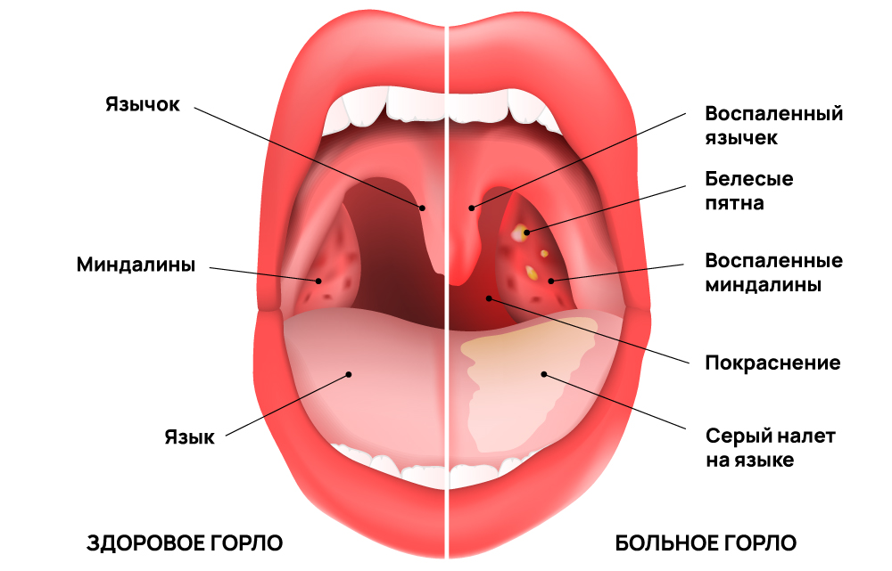 Сравнение здорового и больного горла
