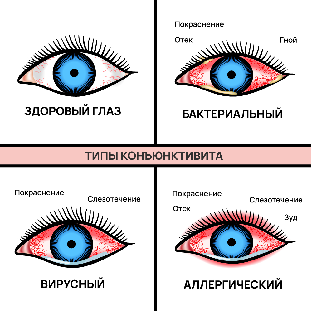 Виды конъюнктивита