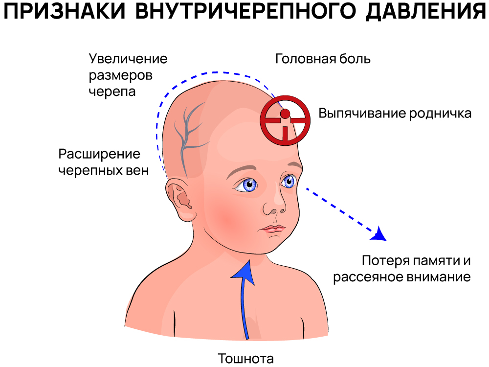 Признаки внутричерепного давления