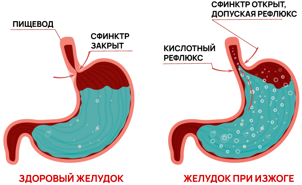 Механизм возникновения изжоги