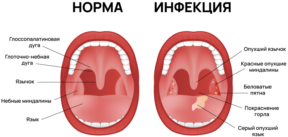 Инфекция в горле