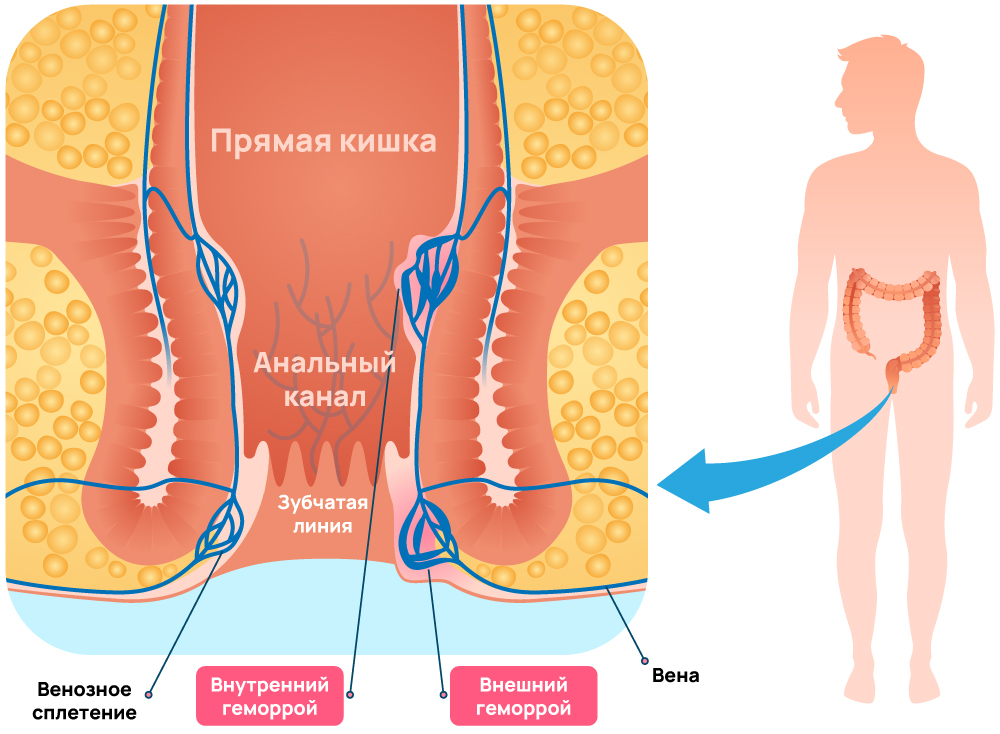 Виды геморроя