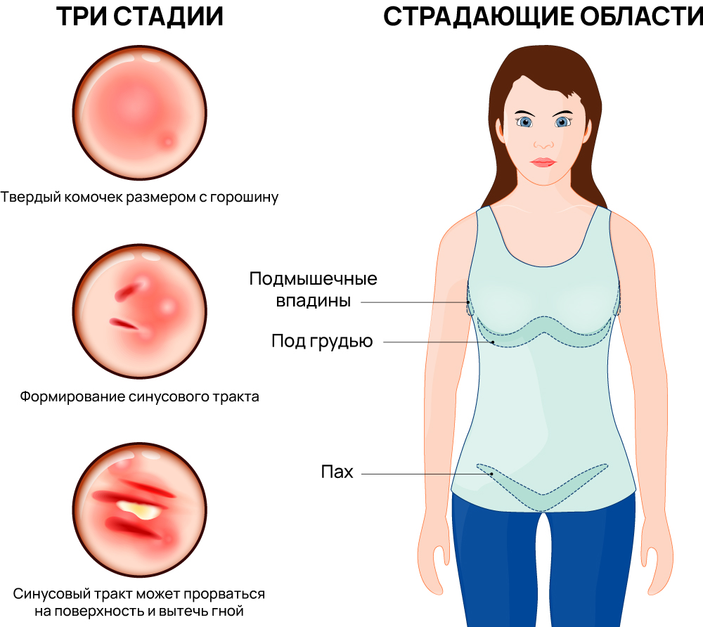 Стадии гидраденита