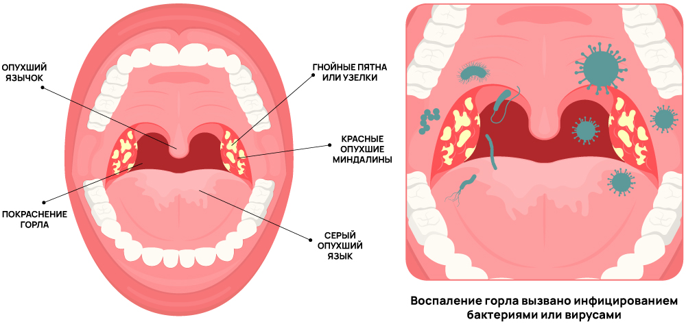 Симптомы гнойной ангины