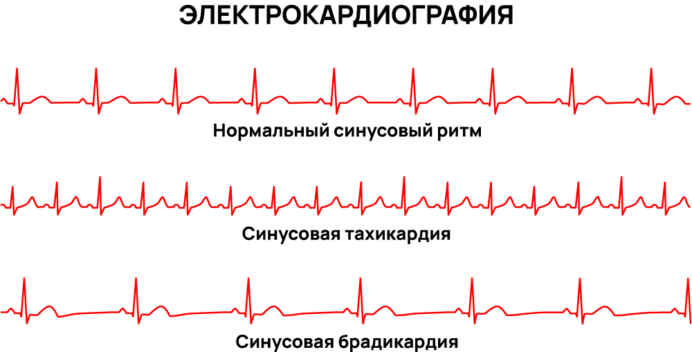 Электрокардиография сердечных патологий