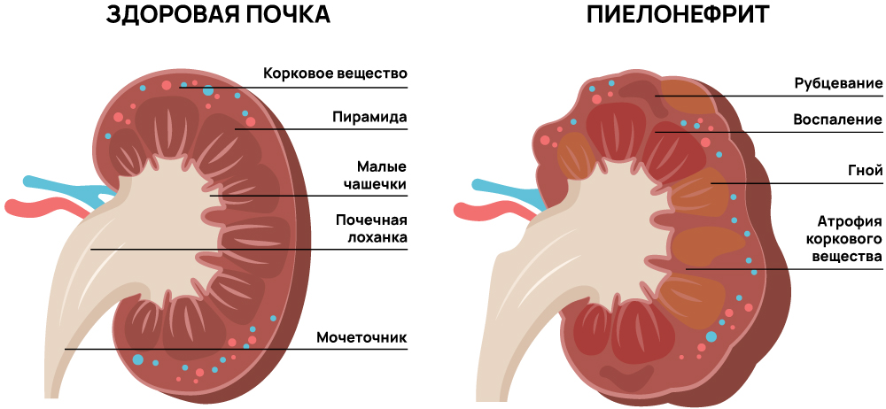 Пиелонефрит почки