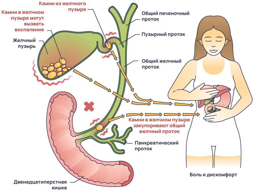 Холецистит