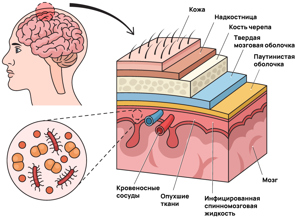 Менингит в голове человека