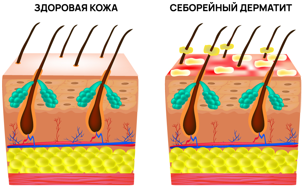 Себорейный дерматит и здоровая кожа