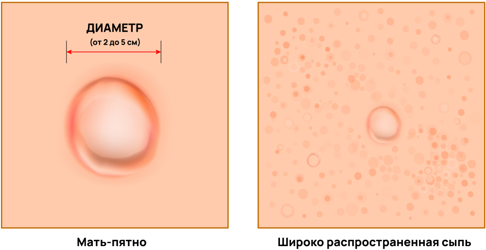 Как выглядит лишай Жибера