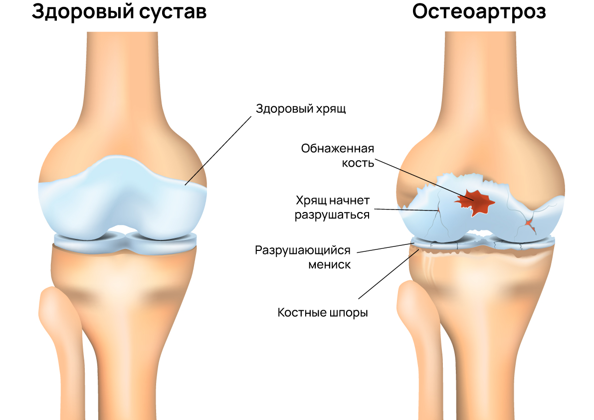 Как выглядит остеоартроз