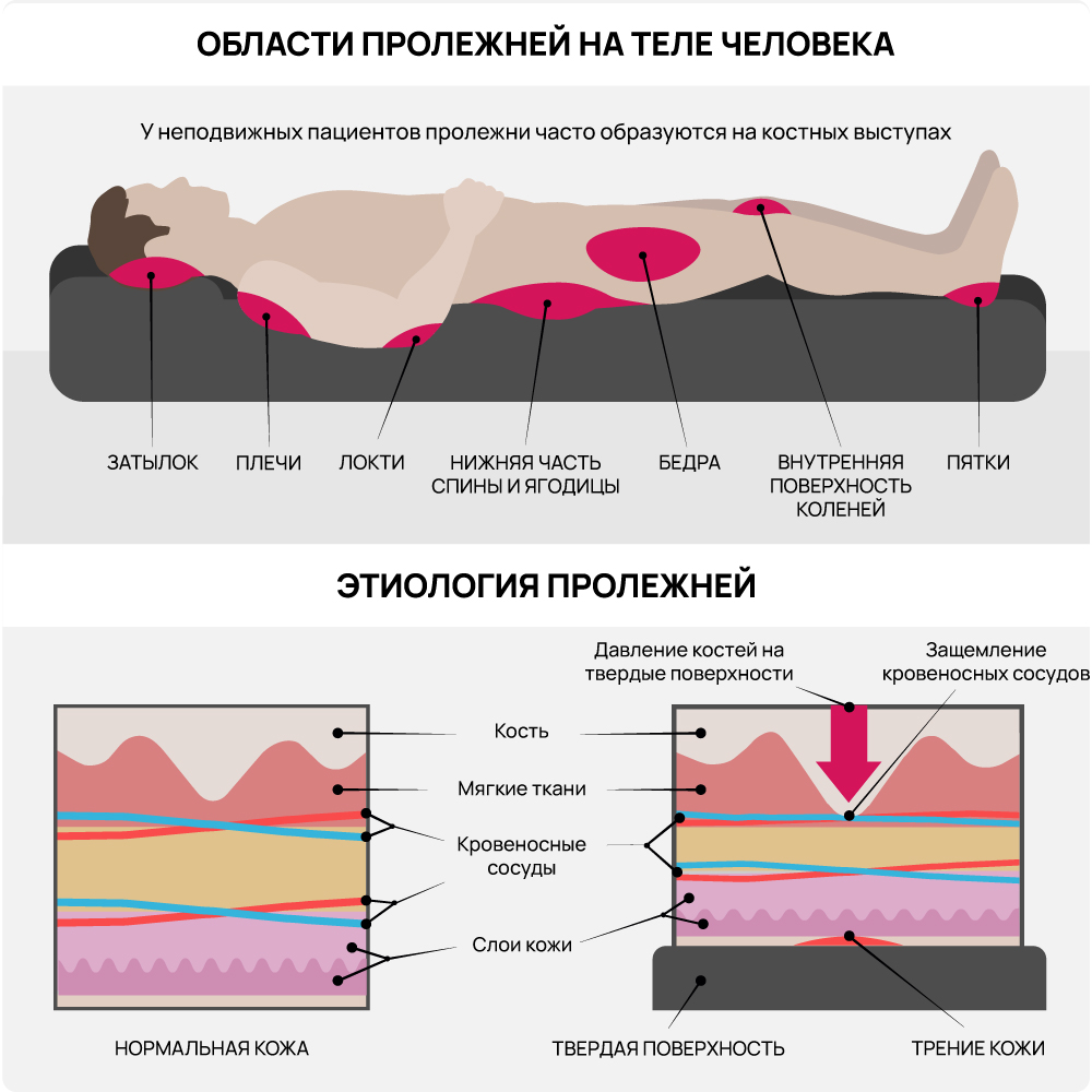 Пролежни на теле человека