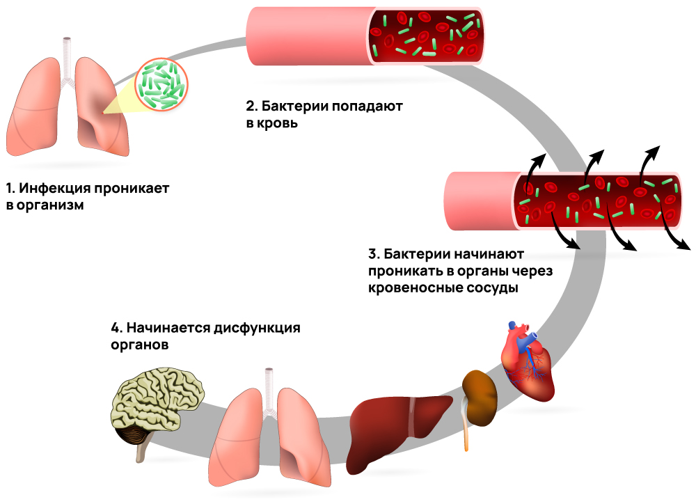 Этапы сепсиса