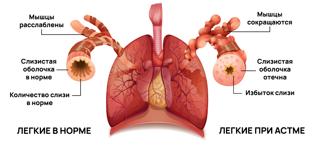 Легкие при астме