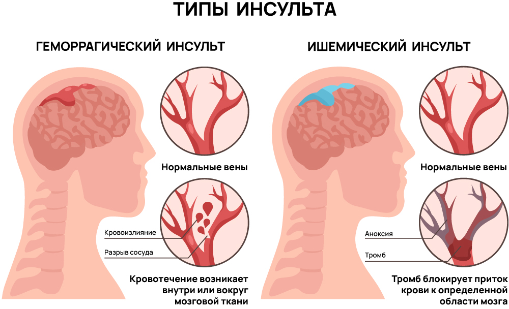 Типы инсульта