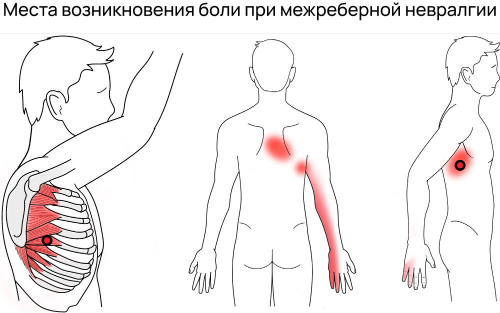 Очаги боли при невралгии